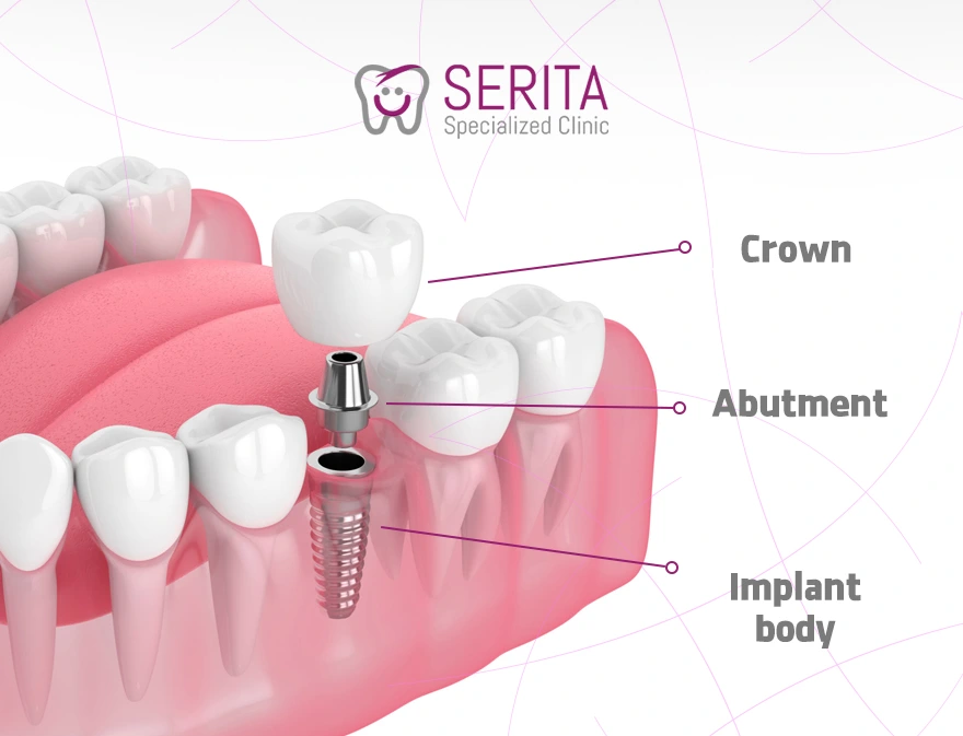 Dental Implants