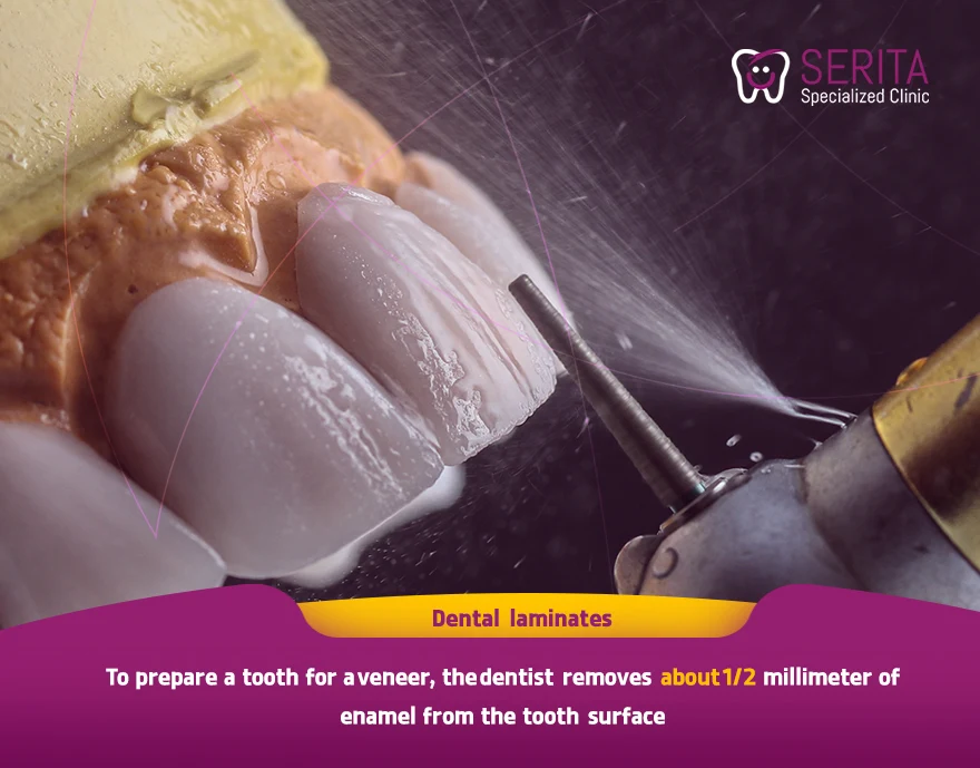 Dental Laminate Procedure